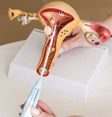 Intrauterine Insemination